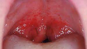 Both basal and squamous cell carcinoma, the two most common types of skin cancer, could be found on the lip. Purpura Causes Diagnosis Treatment And Pictures