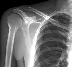 Image result for Shoulder XRay
