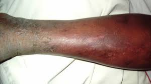 May 31, 2018 · a few minor signs to help you know if your cut is infected include you notice some swelling around your cut. Infected Cut Symptoms Treatment Prevention Complications