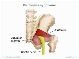 Piriformis Syndrome Sports Spine Rehabilitation Center Yoav Nagar D C North Hollywood Chropractor Sciatic Nerve Piriformis Syndrome Piriformis Muscle