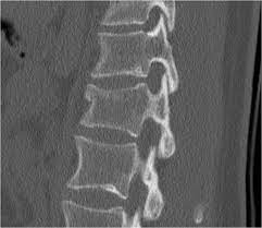 We did not find results for: The Radiology Assistant Tlics Classification Of Fractures