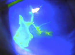 Steroids play a role for treatment in some patients. Herpes Keratitis Core Em