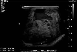 1, 2 the differentiation of tumours with us, however, remains challenging due to significant overlap of imaging features between different tumour types. Medpix Case Mixed Germ Cell Testicular Tumor