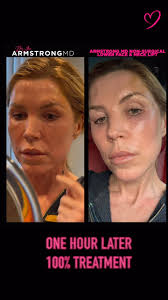 Not everyone loves Threads—and that’s totally okay., Introducing the  Armstrong MD Non-Surgical Face & Neck Lift: our signature treatment to  lift, tighten, and define—no threads, no scalpel, no ...