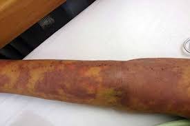 Cs cancer, infection and sepsis fact sheet a potentially deadly combination every cancer patient should know about in your fight against cancer, arm Sepsis Signs Symptoms And Sofa Ausmed