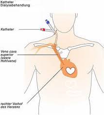 Dialyseshunt