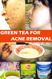 How You Can Use Inexperienced Tea To Take Away Pimples Quick Common Skin Problems Solutions Pimples Remedies How To Treat Acne Back Acne Treatment