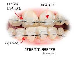 7 Tips To Prevent Ceramic Braces From Staining Ceramic Braces Ceramic Braces Stain Braces Colors