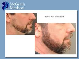 What is a beard transplant beard transplants are exactly what the name implies; Facial Hair Transplant Beard Before And After Facial Hair Transplant Hair Transplant Facial Hair