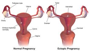 Bleeding is also very common following a short period of amenorrhea. Ectopic Pregnancy Wikipedia