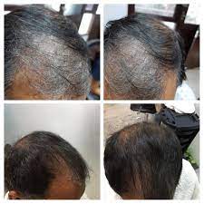 Henna is a hair conditioner and a natural way to color hair or create subtle highlights in hair depending on your starting color. Have You Been Able To Reverse Premature Graying If Yes How Quora
