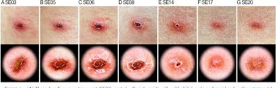 •stable (dry, adherent, intact without erythema or fluctuance) eschar on the Figure 1 From Evolution Of Eschar In Scrub Typhus Semantic Scholar