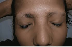 Eyebrow hair loss, the medical name for which is eyebrow hypotrichosis, or eyebrow madarosis, can cause a person to notice thinning hair or missing patches of hair in their eyebrows. How To Identify And Prevent Eyebrow Hair Loss Hair Sure