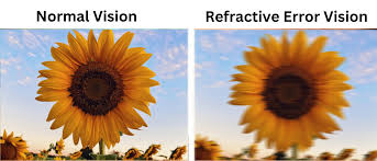 Image result for Refractive Error