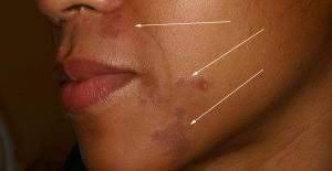 The disease can be transmitted during childbirth, by airborne droplets, through mucous membranes, dirty water, food. Lupus Sintomas At Sanhi Mediko Ph