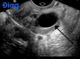 Siêu âm buồng trứng là gì? Siêu âm buồng trứng như thế nào?