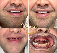 Hi Dent Dr. Ashraf Kamel (@hi.dent.egy) • Instagram photos and videos