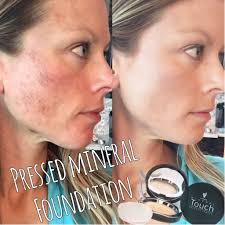 Younique Touch Mineral Pressed Powder Has Some Serious Coverage And Is 100 Natural This Is 1 Day Post Chemical Peel Younique Chemical Peel Younique Touch