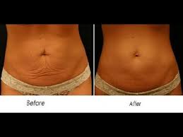 This article will explore some of the few ways a woman can get rid of this loose skin on the stomach and also on other parts of the body: How To Get Rid Of Loose Skin After Pregnancy Youtube