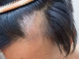 Treatment of male and female pattern hair loss // j. Trichotillomania Archives North Mississippi Hair Loss Solutions Tupelo Ms
