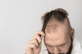 Buzz thinning hair down to a quarter inch or shorter, or go all the way and shave all the way down many men prefer the freedom and ease of upkeep that shaved hairstyles offer. How Men Should Style Thinning Hair