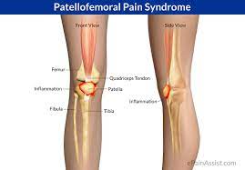 Itb Syndrome Vs Patellofemoral Pain Capital Area Pt Wellness