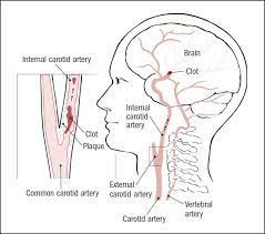 Common carotid arteries travel superiorly in the neck in the carotid sheath in close proximity to the jugular veins, vagus nerve, and recurrent laryngeal nerve. Carotid Artery Disease Harvard Health