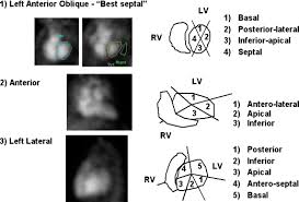 Image result for Nuclear Ventriculogram