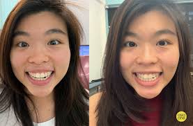 Official website malaysian rubber board lembaga getah malaysia. I Swear By Teeth Straightening Service Zenyum But Here S The Catch Lifestyle News Asiaone