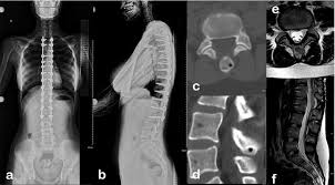Diagram of human organs back view human anatomy chart human body diagrams wikimedia commons human body human body organs diagram from the back. Female 17 Years Old She Had Complaint Of Back Pain And Operated With Download Scientific Diagram