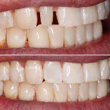 Peg Lateral Fixed With Bonding Orthodontics Treats Cosmetic Dentistry