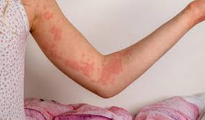 Image result for Hives