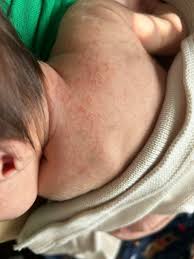Image result for sweat rash on back baby