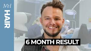 Hair Transplant Results