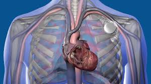 Image result for Cardiac Resynchronization Therapy
