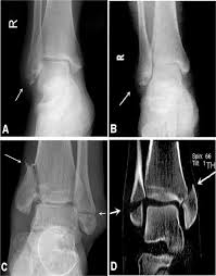 A computed tomography scan is imperative to evaluate fragment size, comminution, articular impaction, and syndesmotic disruption. Radiographic Analysis Of Adult Ankle Fractures Using Combined Danis Weber And Lauge Hansen Classification Systems Scientific Reports