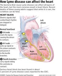 Lyme Disease And The Heart The Boston Globe Lyme Disease Lyme Disease Awareness Lyme Disease Treatment
