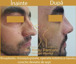 Cu ajutorul septoplastiei, septul nazal este indreptat, permitand o mai buna circulatie a aerului prin nas. Avantaje Si Riscuri Rinoplastie Interviu Dr Radu Panturu