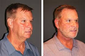 The best treatment for saggy jowls is not a laser treatment. Male Facelift Best Male Facelift Surgeon Male Face Lift Nyc
