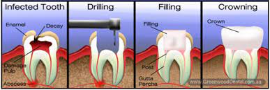 Once the tooth has been root canal treated, it generally has to go for a crown on top of it. Root Canal