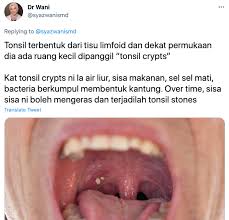 Basah tuala dengan air sejuk dan tekap pada mata. Ketulan Putih Berbau Busuk Dalam Mulut Doktor Gigi Ini Jelaskan Punca Sebenar Tonsil Stones Rapi