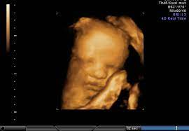 My Amazing 4d Scan At 33 Weeks