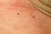 Beginning Breast Cancer Rash