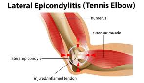 Image result for Elbow Joint Injection
