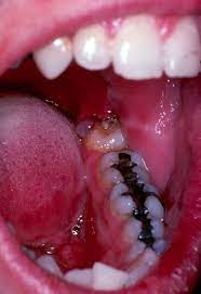 Wisdom Teeth Merrimack Valley Oral Surgeons Inc