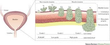 In most cases, blood in the urine (called hematuria) is the first sign of bladder cancer.there may be enough blood to change the color of the urine to orange, pink, or, lessoften, dark red. Bladder Cancer Nature Reviews Disease Primers