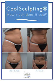 The Plastic Surgery Group Coolsculpting Cost Cool Sculpting Liposuction Alternatives