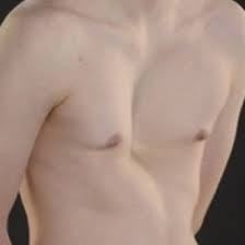 Check spelling or type a new query. Pectus Clinic St Anthony S Hospital