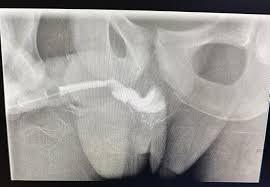 Image result for Retrograde Urethrogram