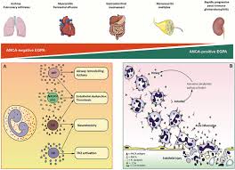 In ganz österreich existieren derzeit insgesamt 25 medizinische fachrichtungen für stationäre behandlungen, wobei nicht jedes krankenhaus alle fachrichtungen anbietet. Frontiers Eosinophilic Granulomatosis With Polyangiitis Dissecting The Pathophysiology Medicine